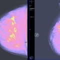 despistage de cáncer de mama en Ceuta