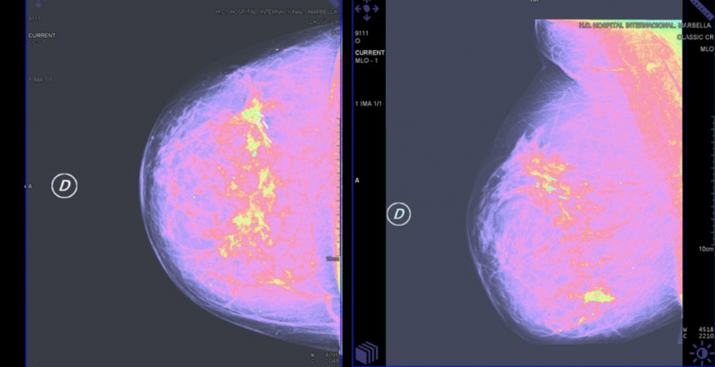 despistage de cáncer de mama en Ceuta